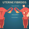 Healthy uterus v. fibroids